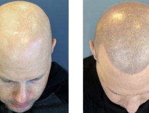 Scalp micro pigmentation